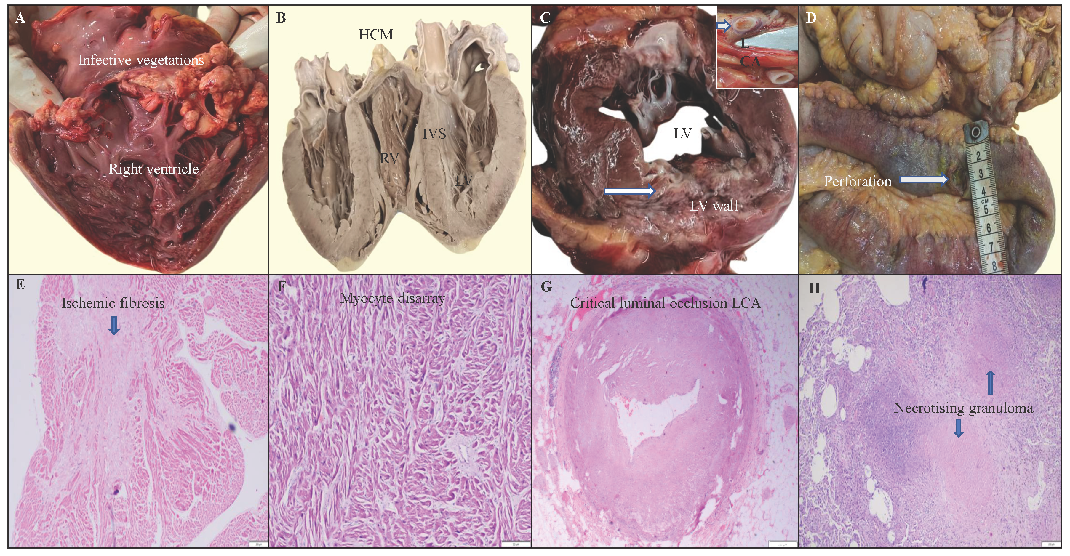 (A) Large friable tricuspid valve vegetation’s in a case of Infective endocarditis. (B) Case of HCM revealing asymmetrical hypertrophy of the interventricular septum (IVS) and left ventricular (LV) free wall. (C) Left ventricular wall showing features of chronic myocardial infarction with complete blockage of left coronary artery (inset). (D) A case of intestinal tuberculosis showing gangrenous bowel segment with perforation (arrow). (E) Cardiac section showing large area of replacement fibrosis in a case of chronic myocardial infarction (2X, HE). (F) Microscopic sections from HCM revealing myocyte disarray, hypertrophy and interstitial fibrosis (20X, HE). (G) Section of left coronary artery showing critical luminal occlusion (more than 75% blockage) due to atherosclerosis (2X, HE). (H) Sections from lung parenchyma showing large areas of caseous necrosis with epithelioid cell granulomas in a case of tuberculosis (4X, HE).